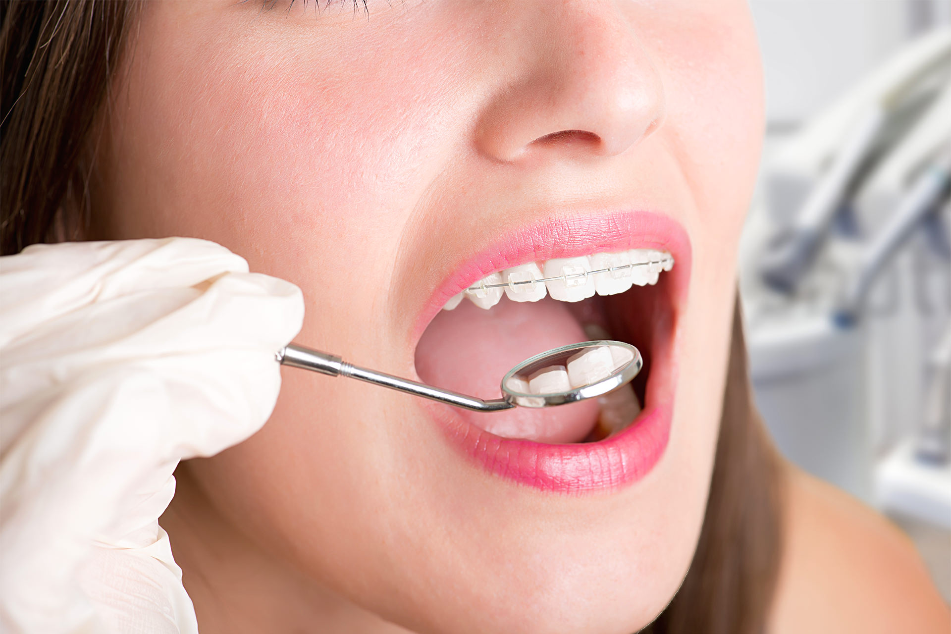 dentaltamayo-tratamiento-blanqueamiento-dental