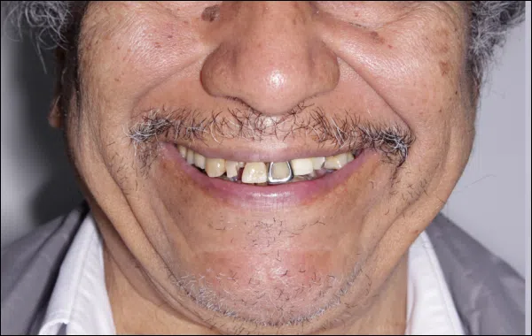 Antes